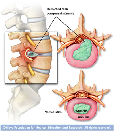 Do Disc Herniations Heal?